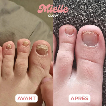 🪄 Stylo réparateur ongles de pieds - Traitement antifongique