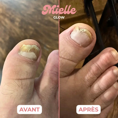 🪄 Stylo réparateur ongles de pieds - Traitement antifongique