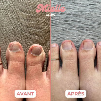 🪄 Stylo réparateur ongles de pieds - Traitement antifongique